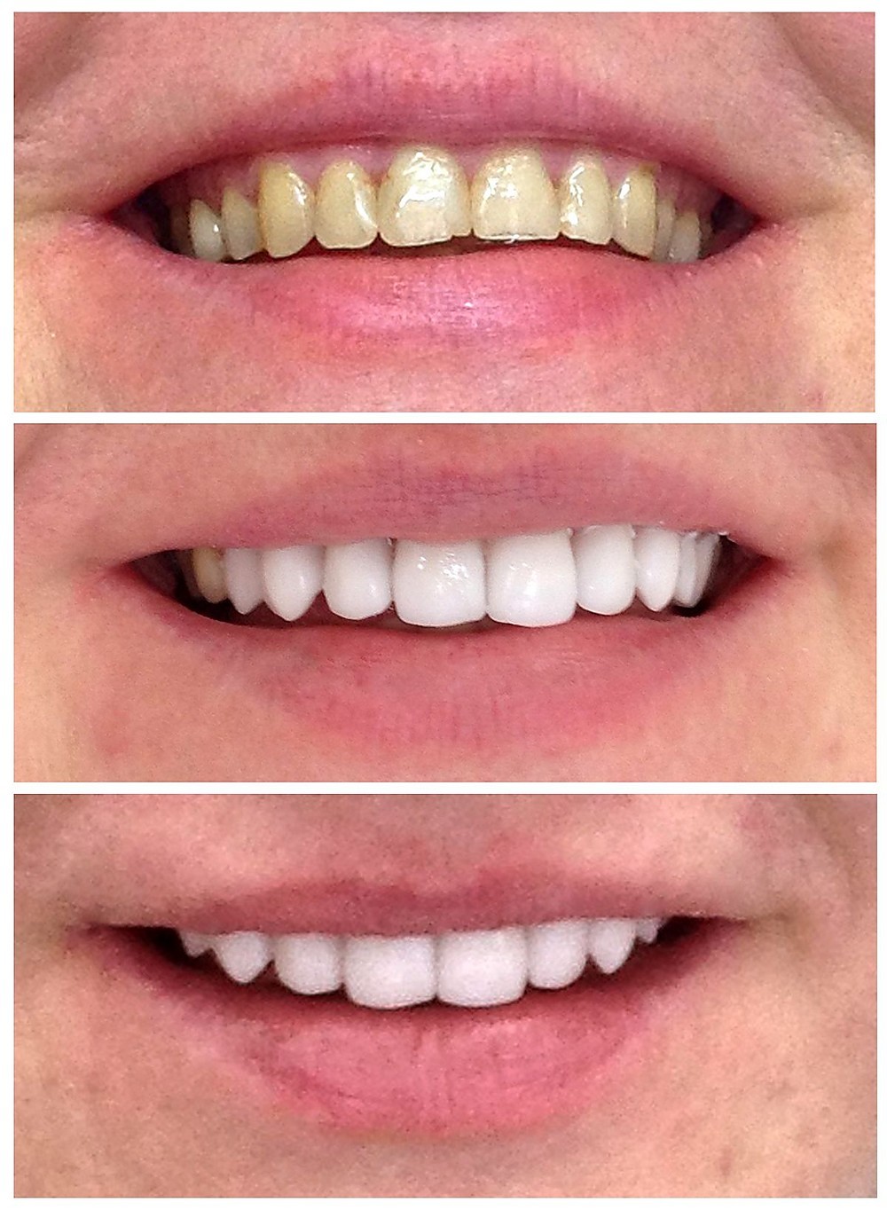 hambaravi enne ja pärast