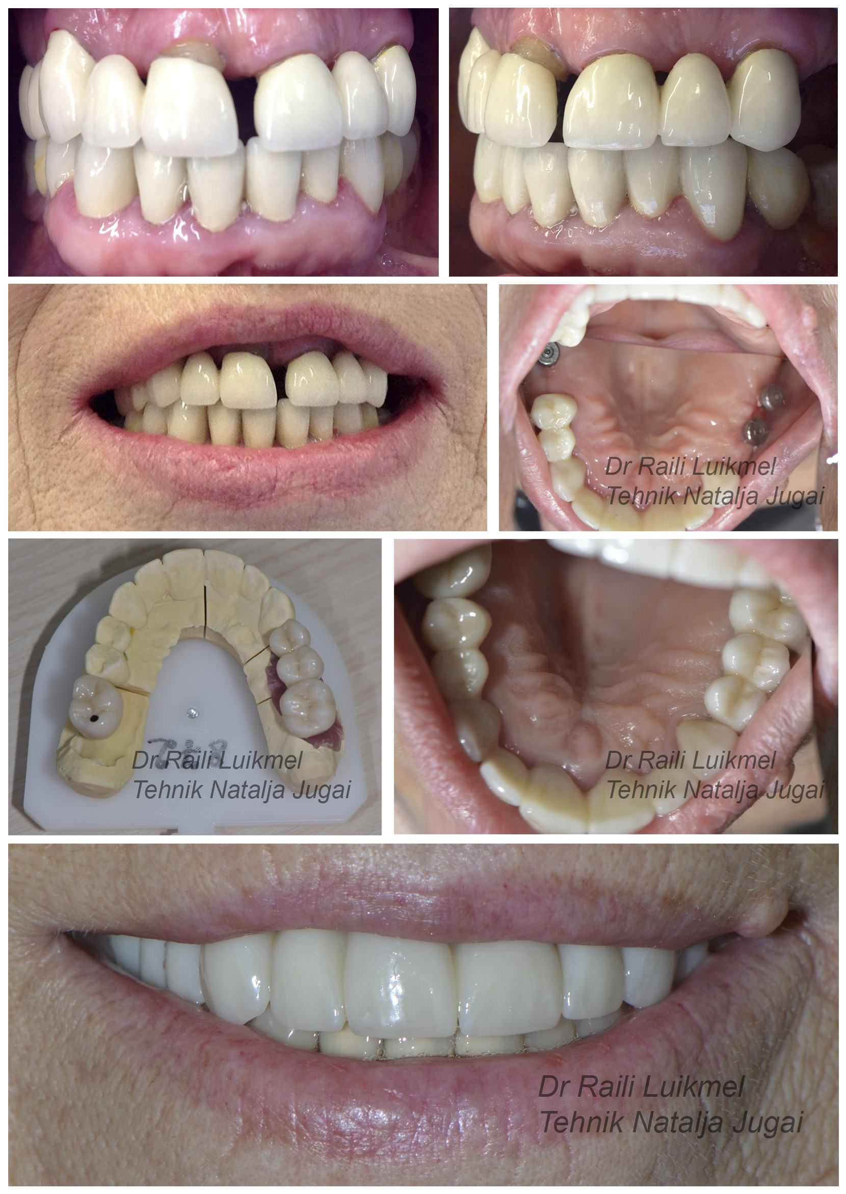 hambaravi enne ja pärast